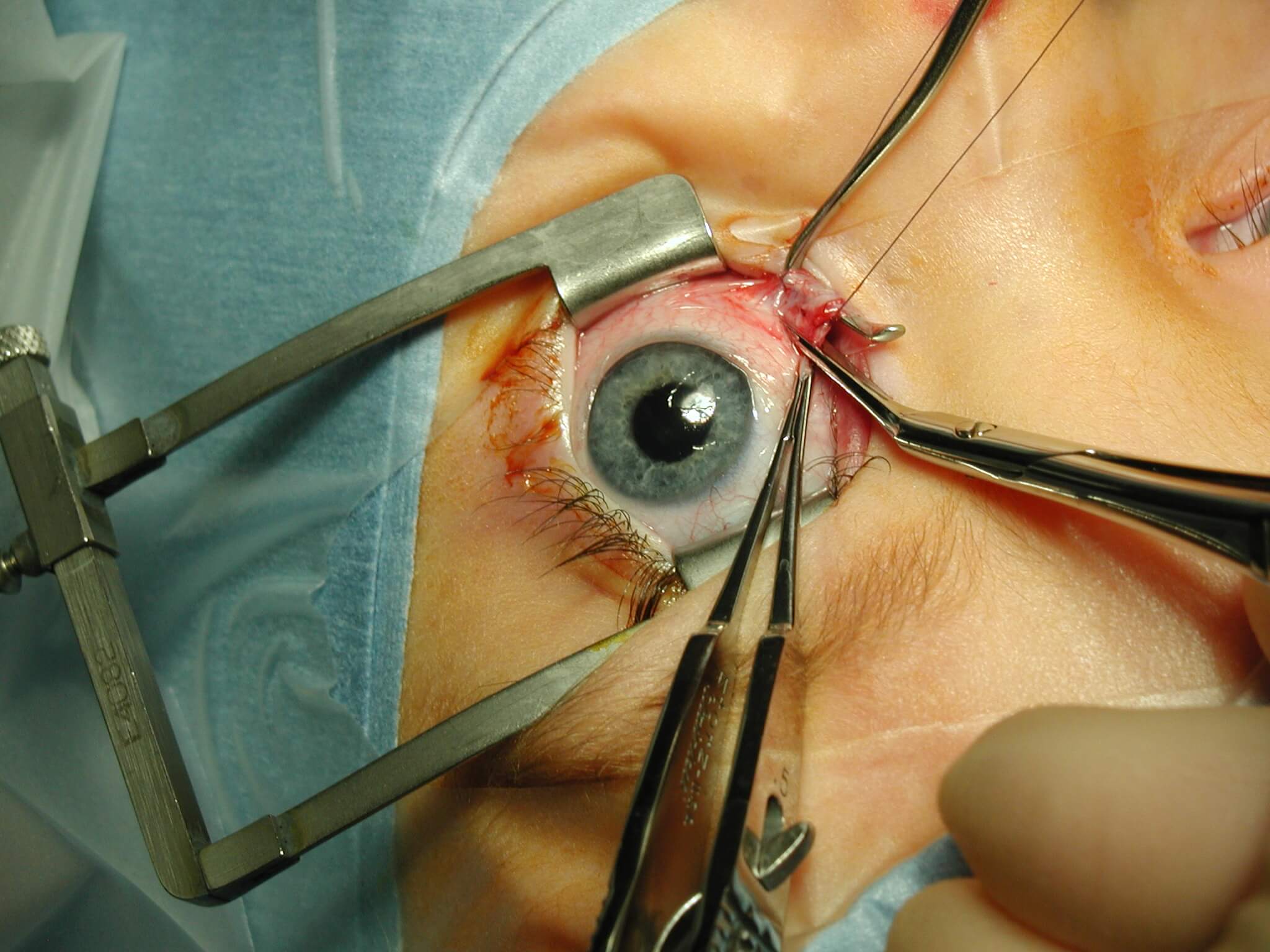 FRONTALIS SLING SURGERY